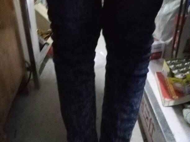 你的腿型是X型吗 来看看这份全面解析与矫正指南